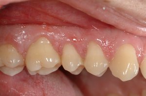 Connective Tissue Graft case study