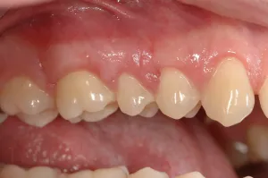 Connective Tissue Graft case study