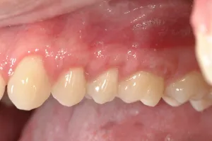Connective Tissue Graft case study