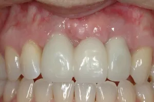 Connective Tissue Graft case study