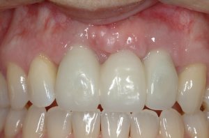Connective Tissue Graft case study