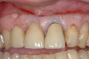 Dental Implants case study