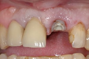 Dental Implants case study