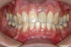 Dental Implants case study