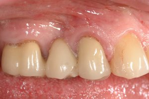 Dental Implants case study