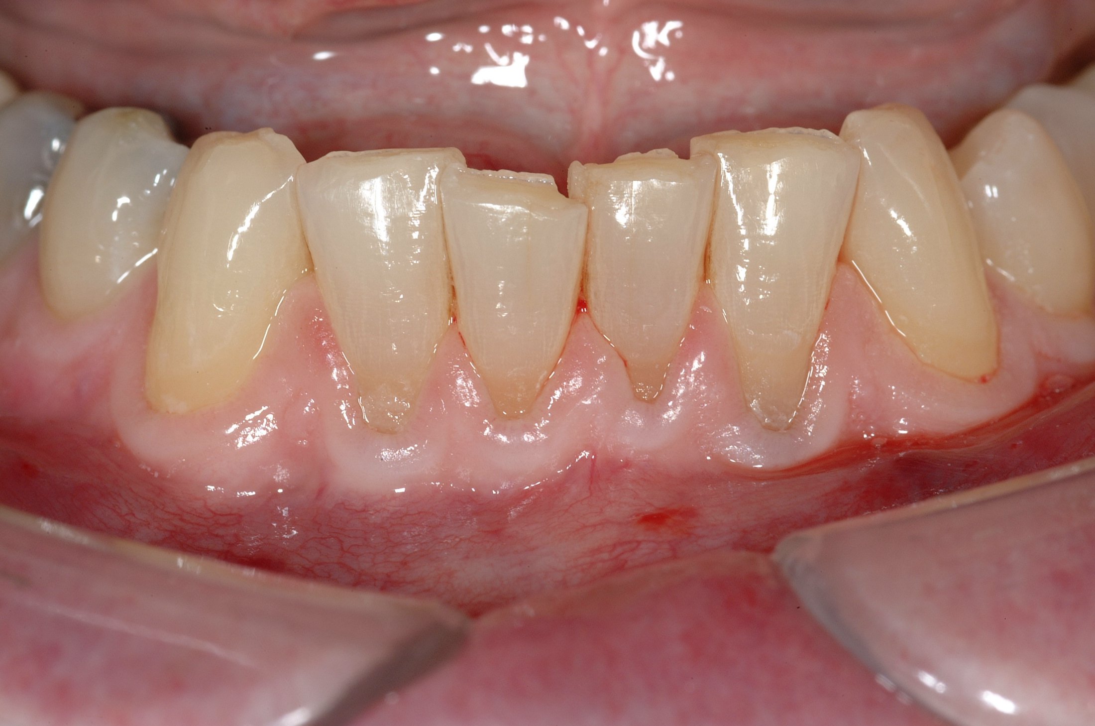 Connective Tissue Graft case study