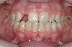 Esthetic Crown Lengthening case study
