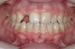 Esthetic Crown Lengthening case study