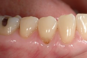 Allograft case study