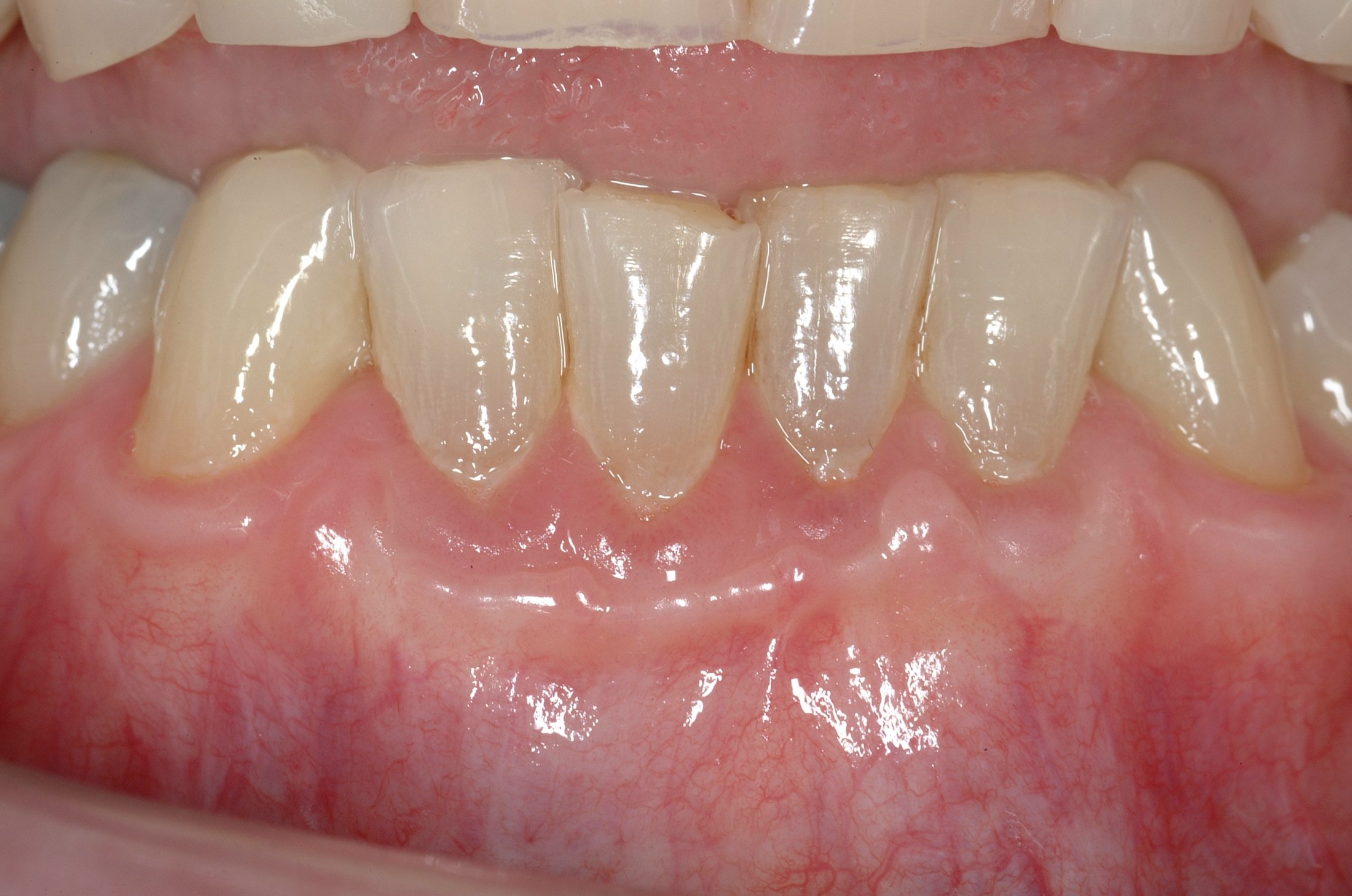 Connective Tissue Graft case study