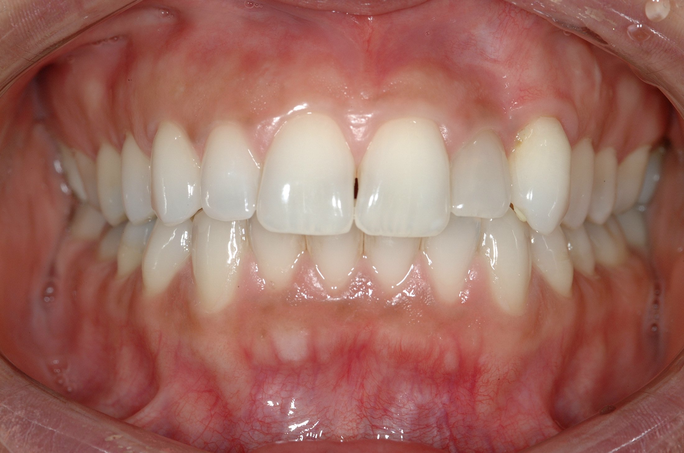 Dental Implants case study