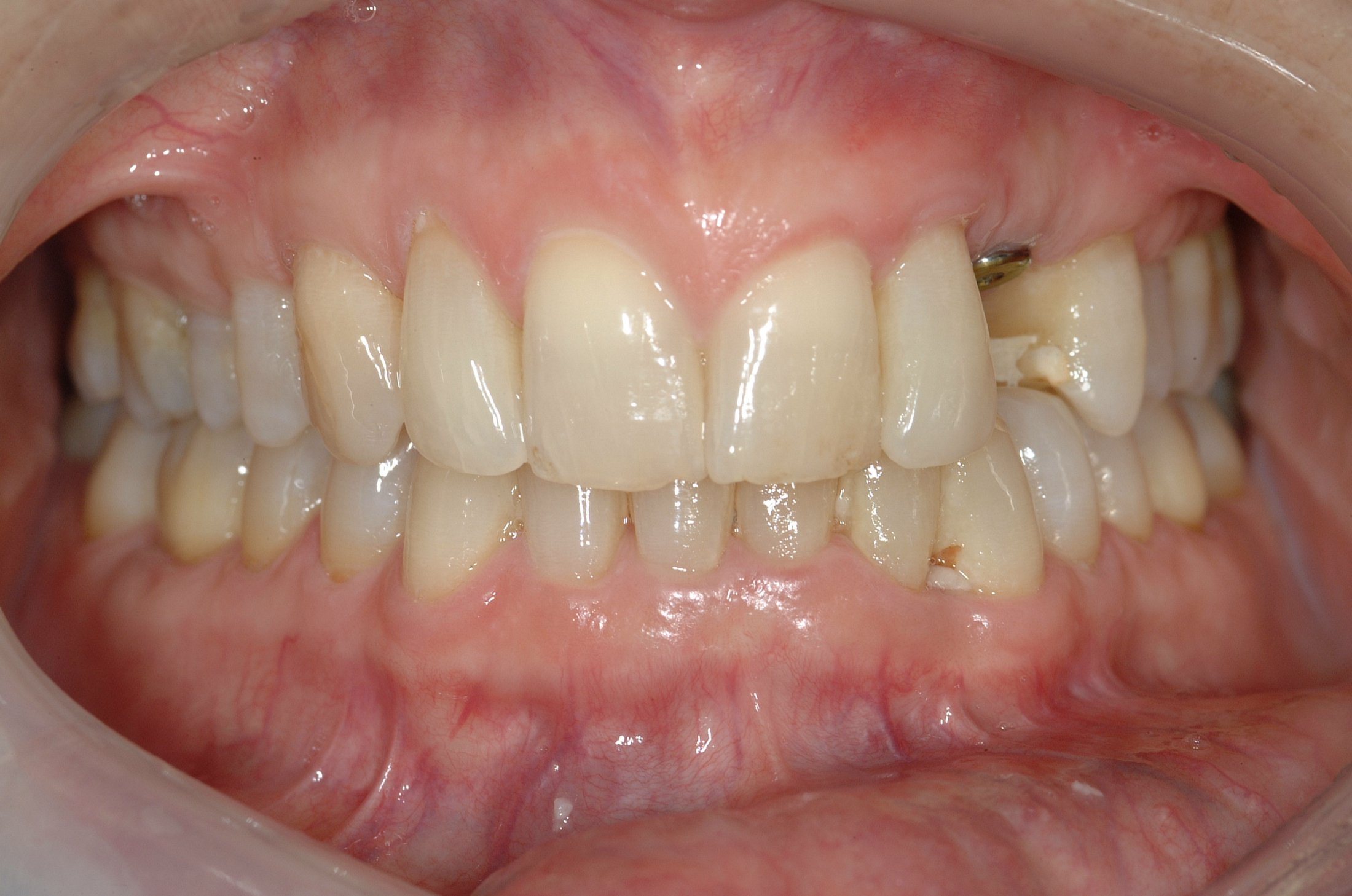 Dental Implants case study