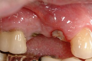 Dental Implants case study