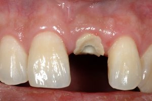 Dental Implants case study