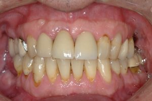 Dental Implants case study
