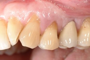 Dental Implants case study