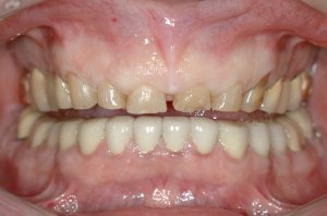 Esthetic Crown Lengthening case study