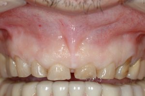Esthetic Crown Lengthening case study