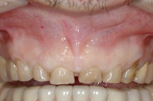 Esthetic Crown Lengthening case study