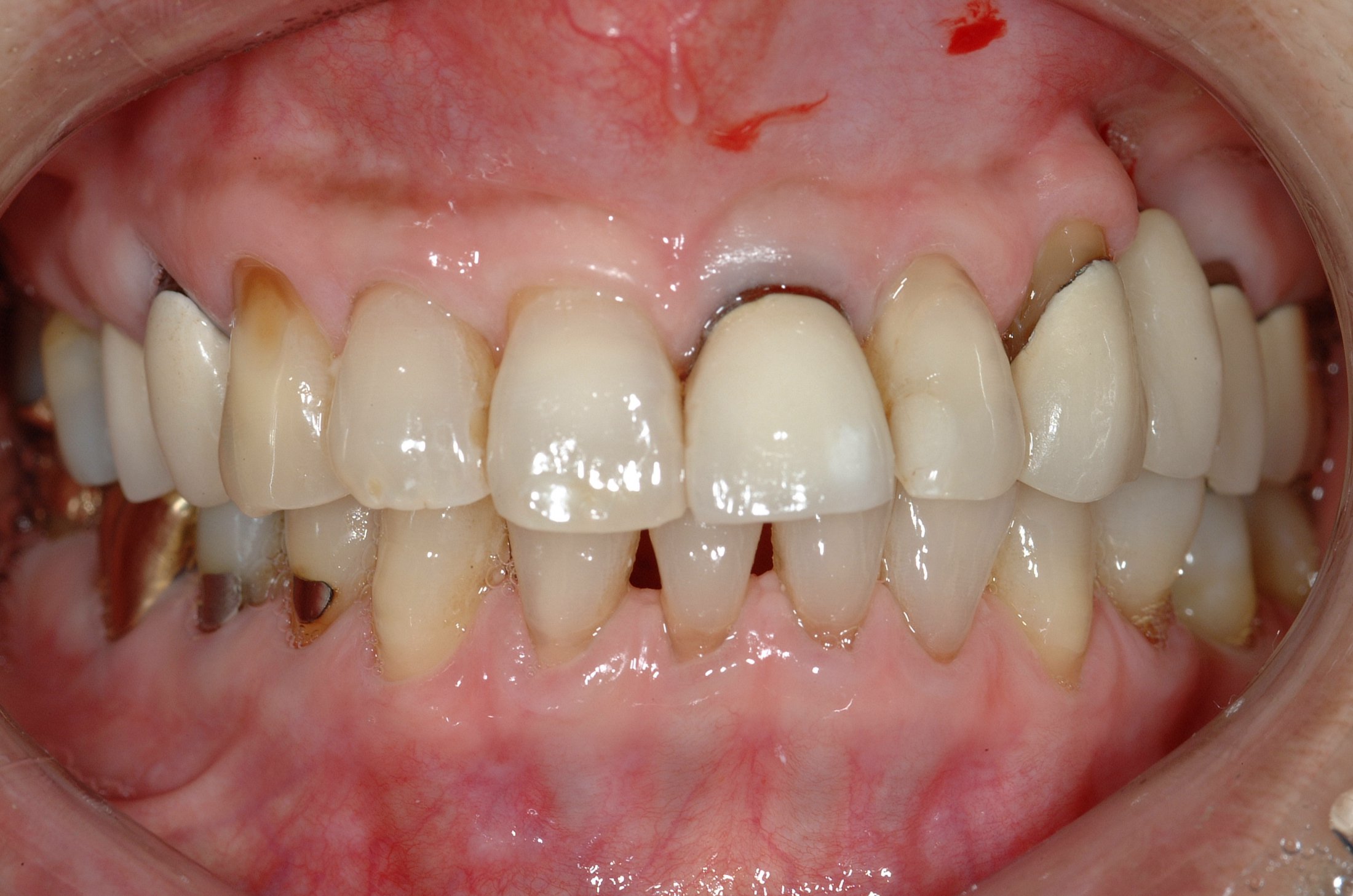Dental Implants case study