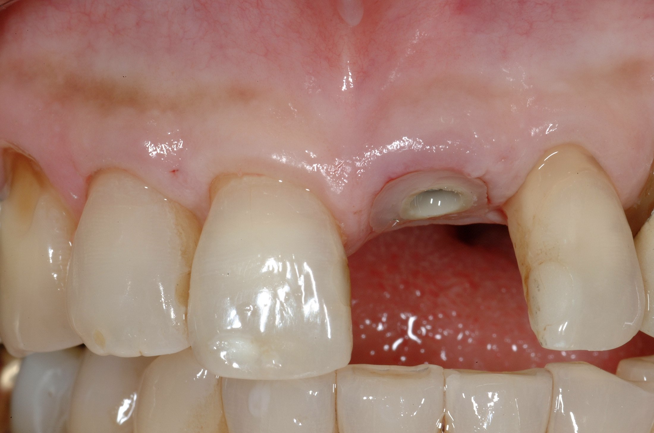 Dental Implants case study