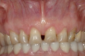 Esthetic Crown Lengthening case study
