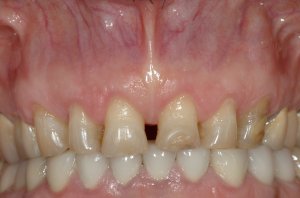 Esthetic Crown Lengthening case study