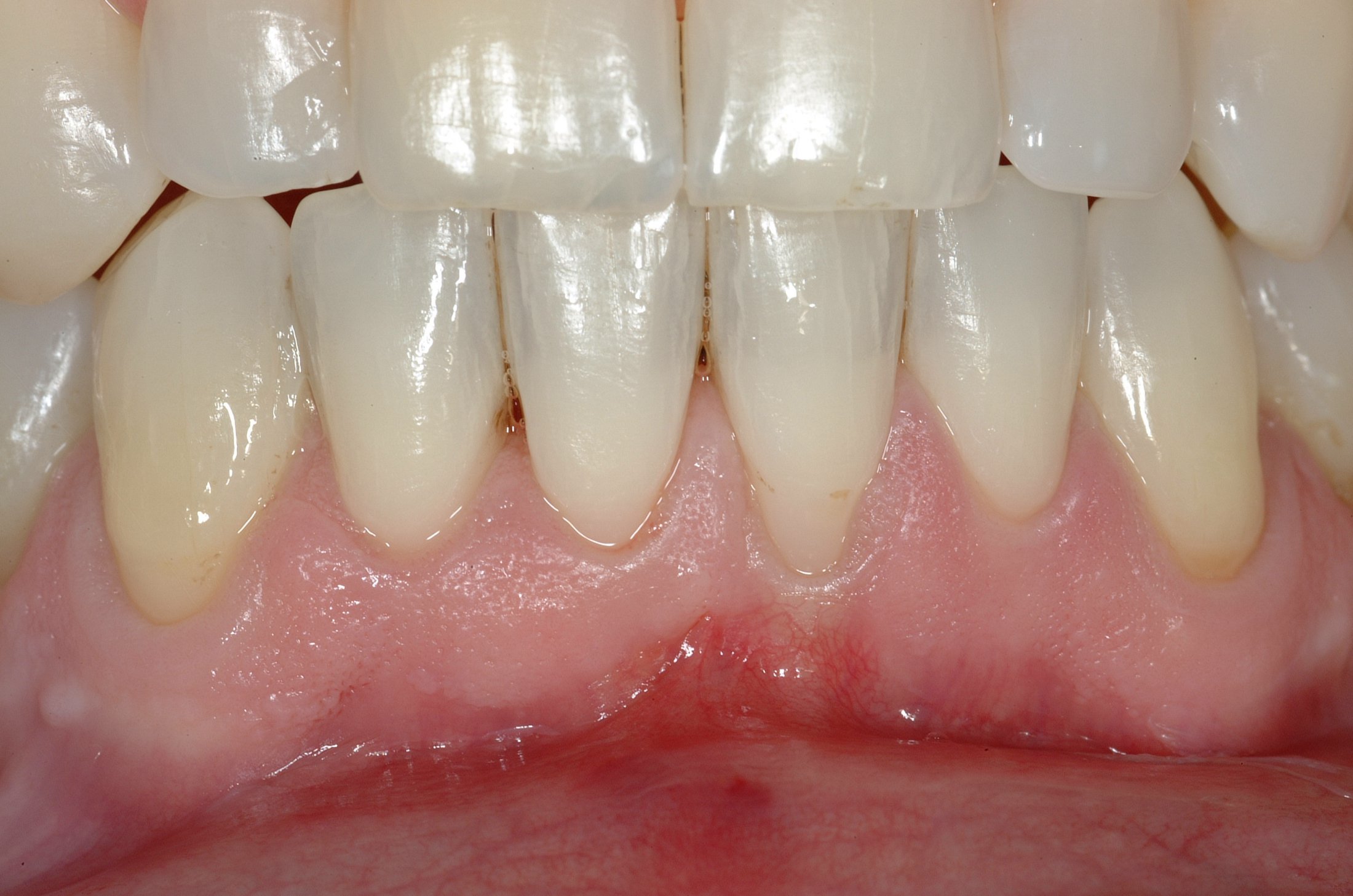 Connective Tissue Graft case study