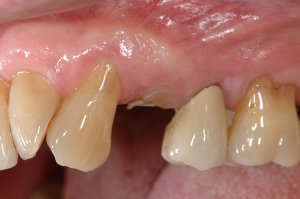 Dental Implants case study