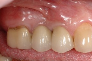 Dental Implants case study