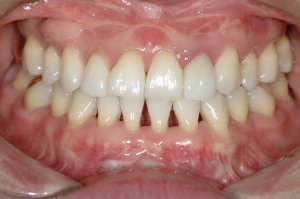 Dental Implants case study