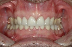 Esthetic Crown Lengthening case study