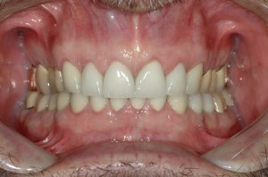 Esthetic Crown Lengthening case study