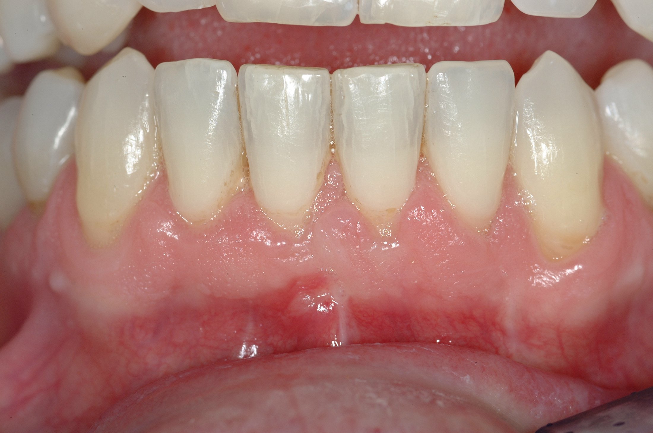 Connective Tissue Graft case study