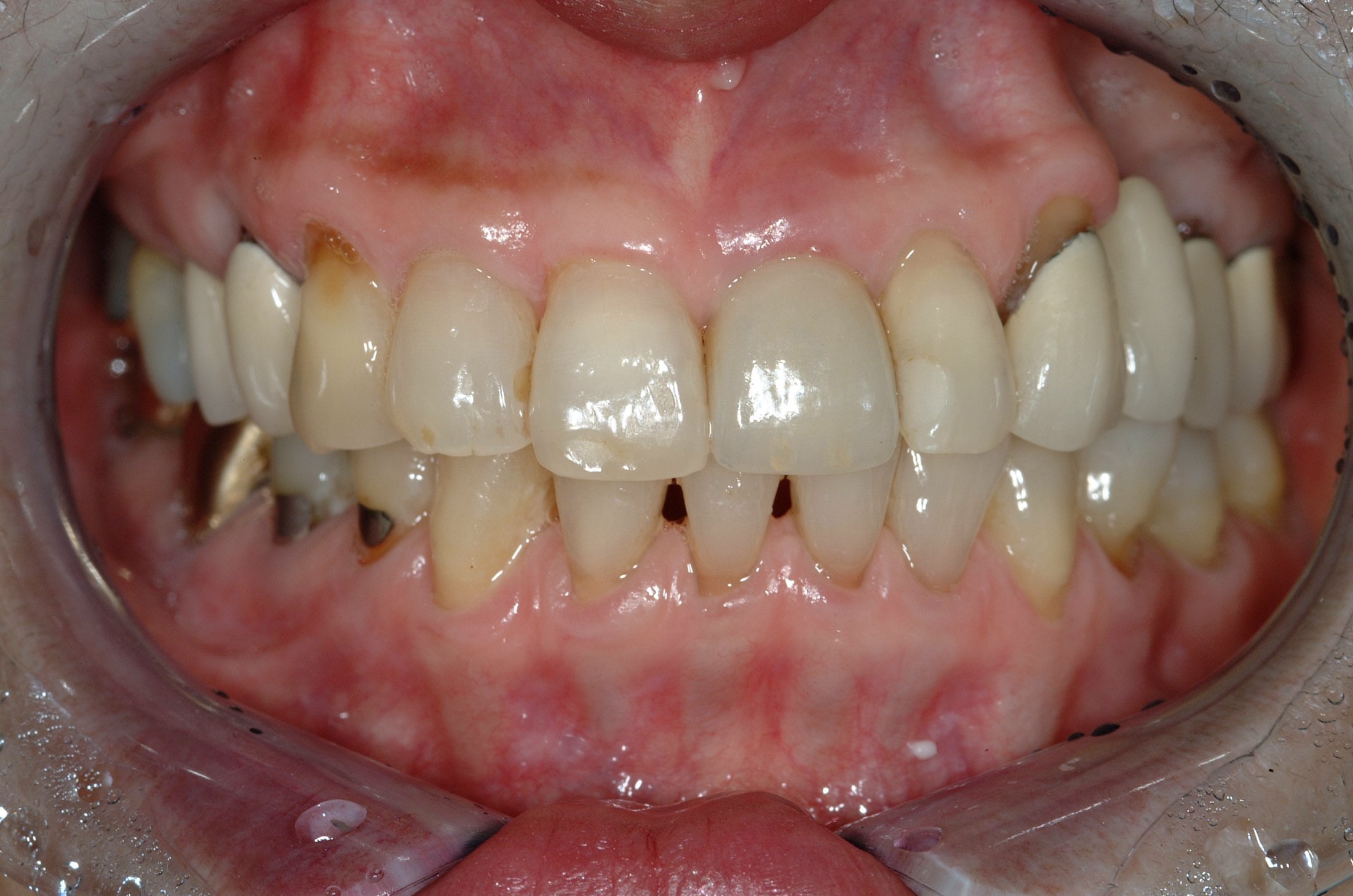 Dental Implants case study
