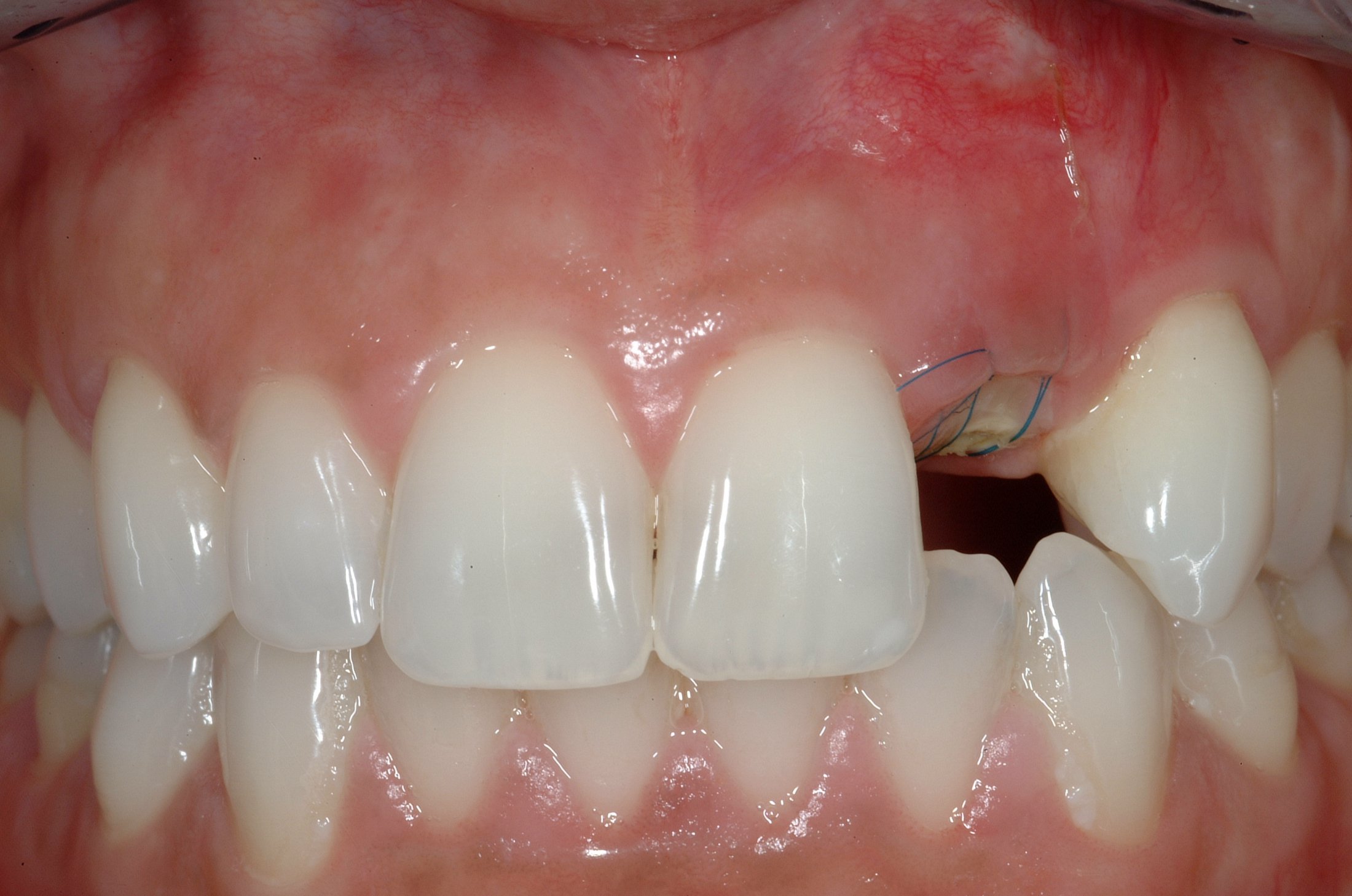 Dental Implants case study