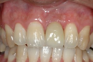 Dental Implants case study