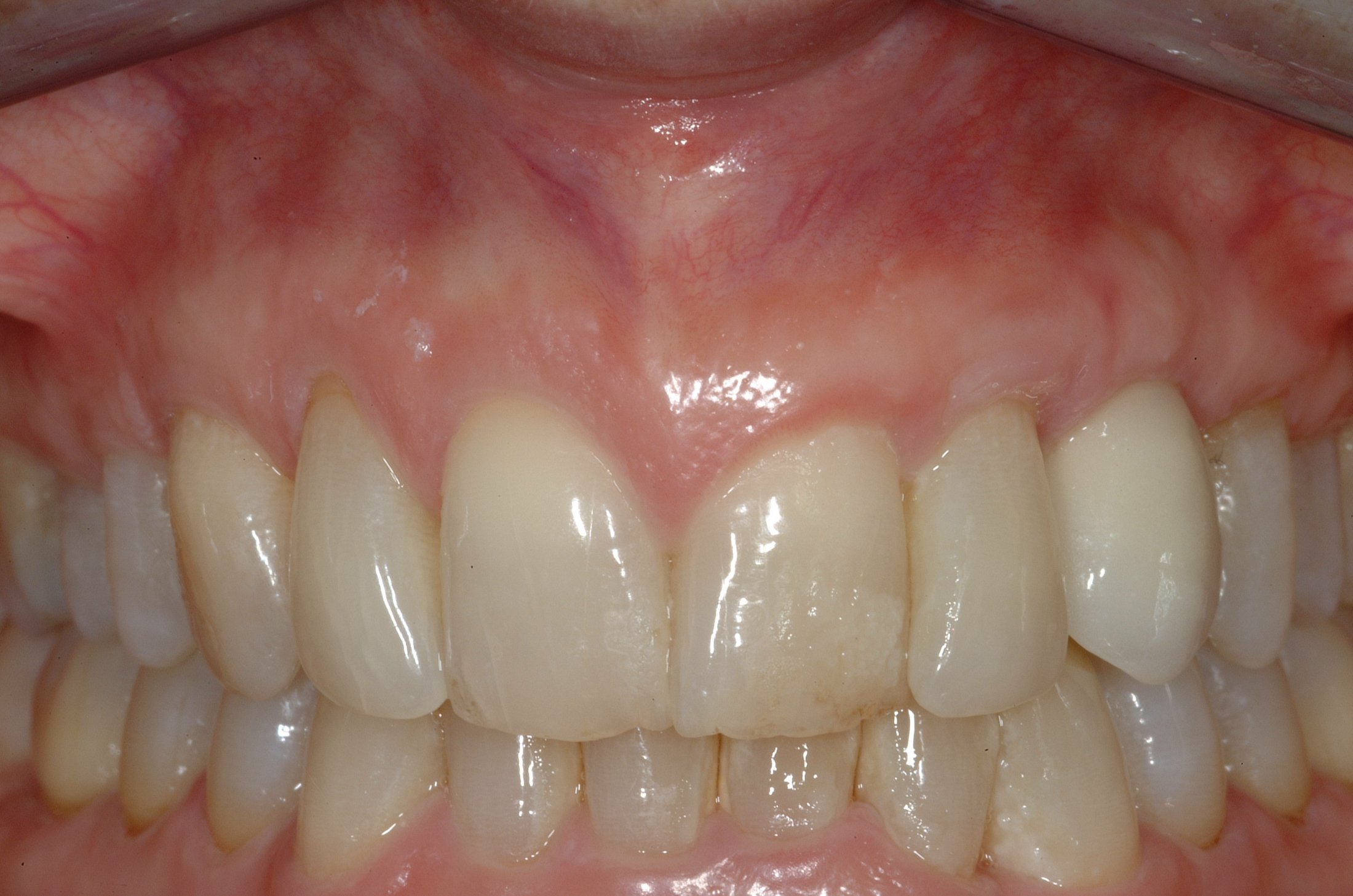 Dental Implants case study