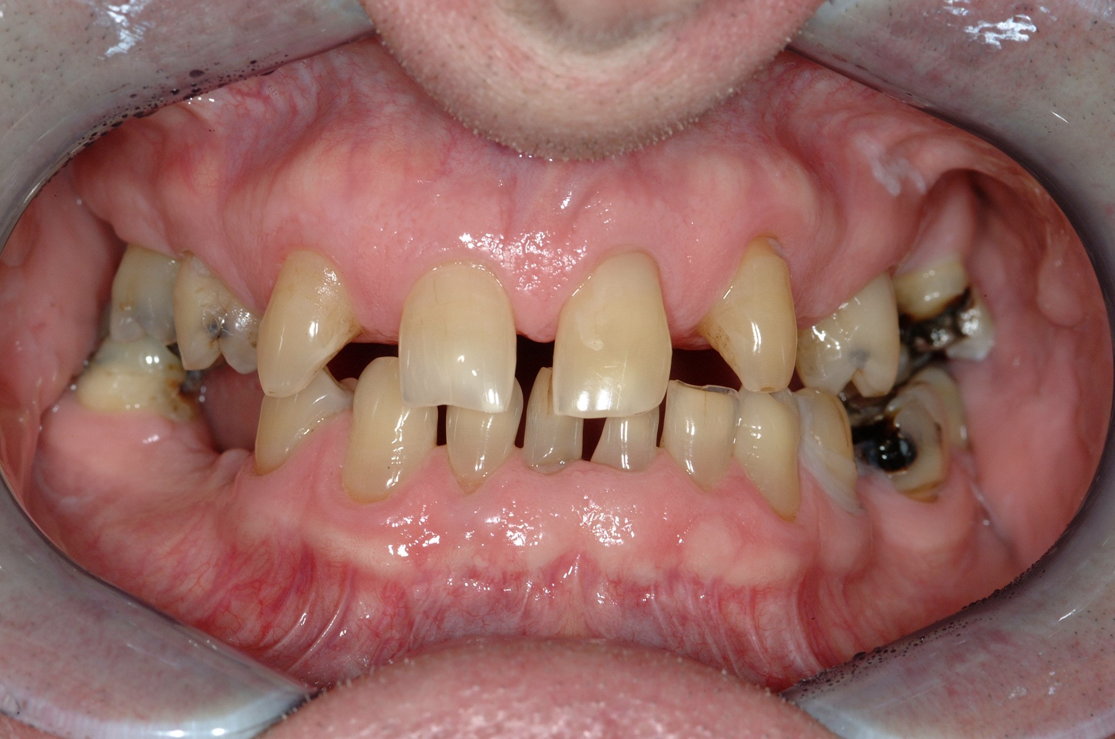 Dental Implants case study