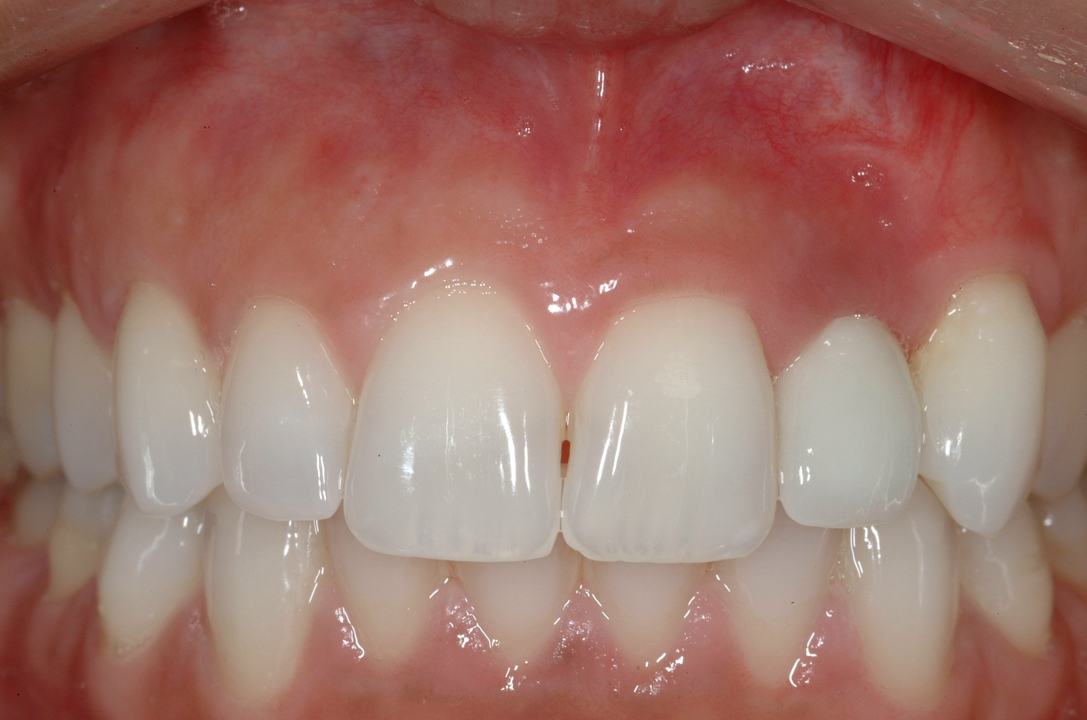 Dental Implants case study