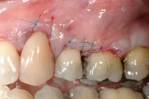 Connective Tissue Graft case study
