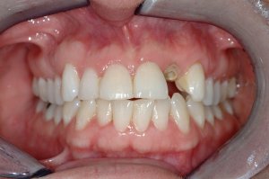 Dental Implants case study