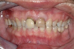 Dental Implants case study