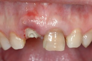 Dental Implants case study