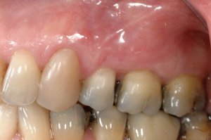 Connective Tissue Graft case study