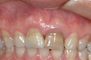 Dental Implants case study