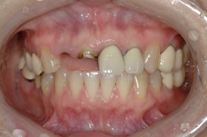Dental Implants case study