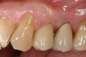 Dental Implants case study