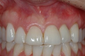 Dental Implants case study
