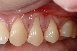 Allograft case study